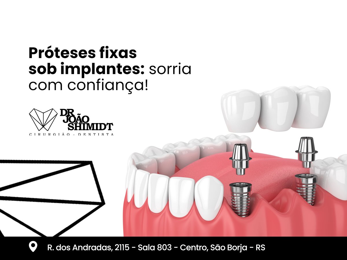 Próteses fixas sob implantas: sorria com confiança!
